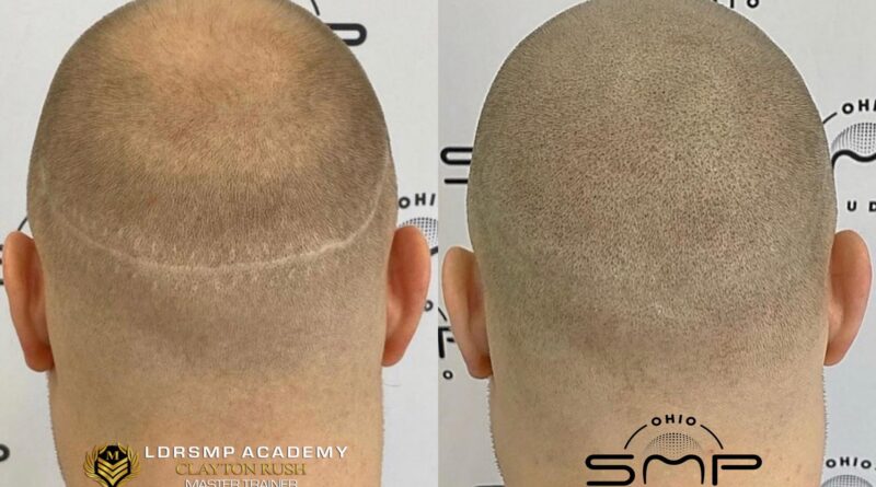 Scalp Micropigmentation