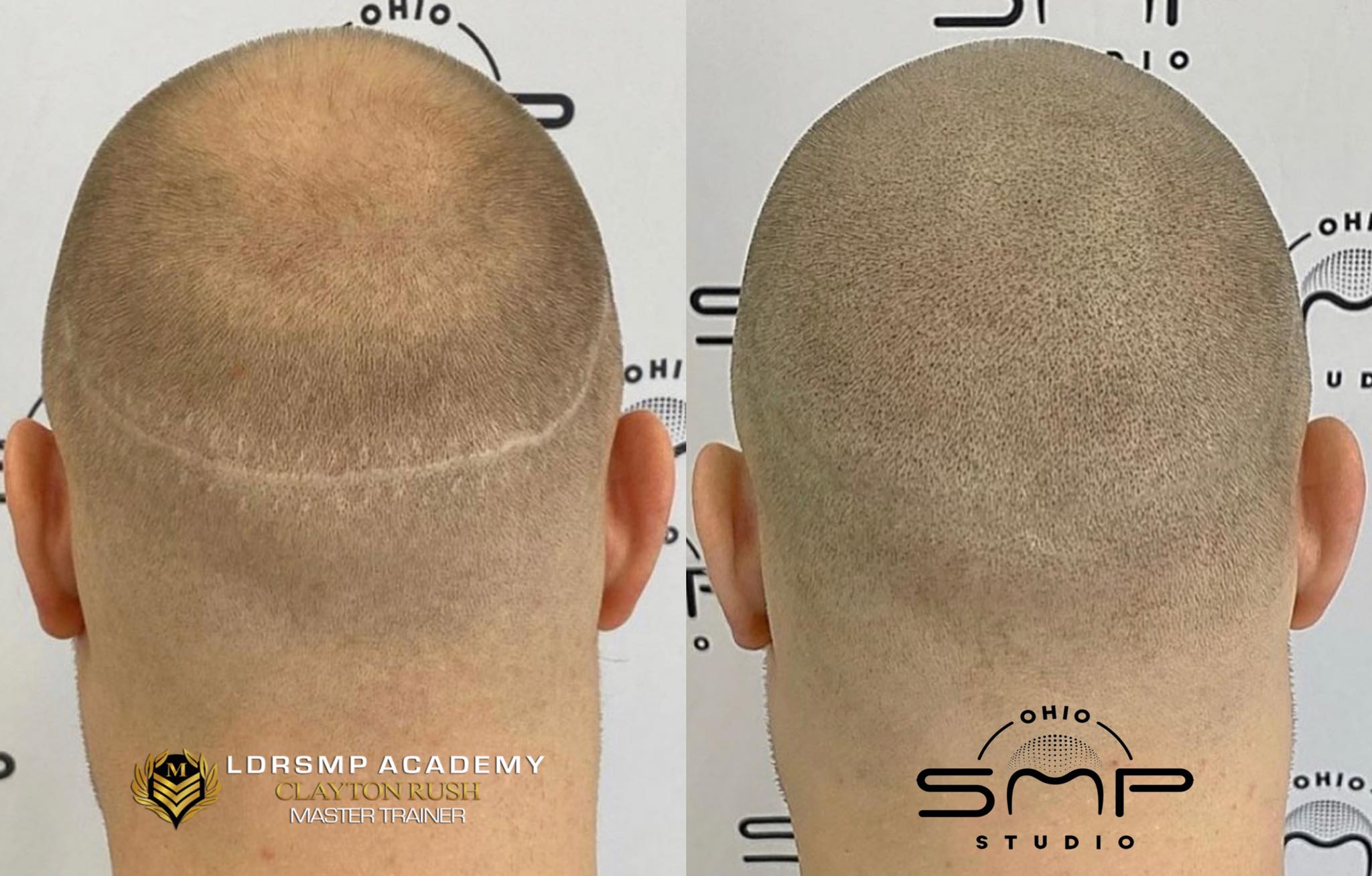 Confidence Restored: Scalp Micropigmentation in Cleveland Heights